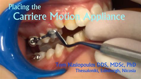 Carriere Placement Tom Nasiopoulos Orthodontist Youtube