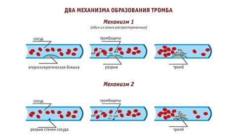 Таблетки для разжижения крови: обзор препаратов с аспирином и без него ...