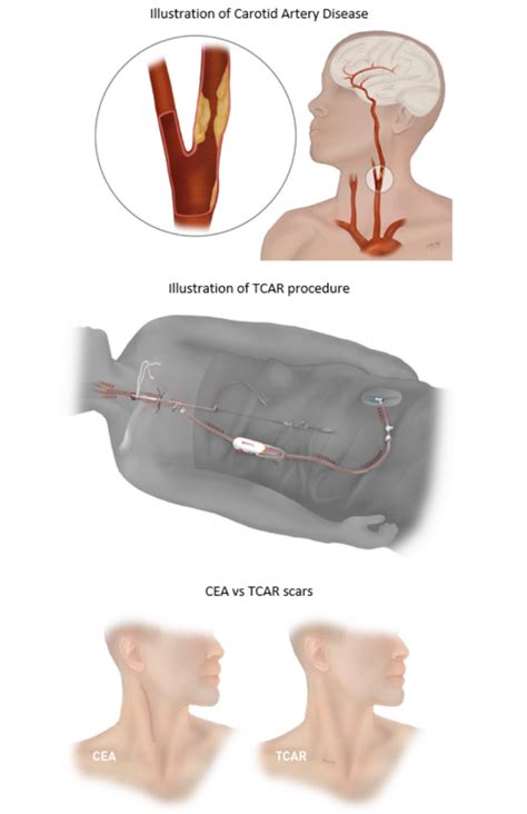 Local Physician To Begin Offering Carotid Artery Procedure