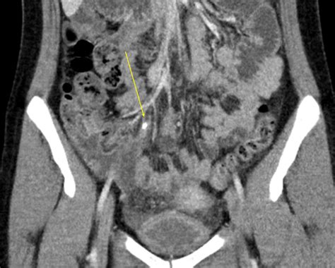 Acute Appendicitis Radiology Case Collection