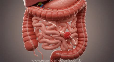 Como É Feito A Cirurgia De Apendicite - Cirurgia de Apêndice e Cólon: Guia Completo sobre Indicações e Técnicas ...