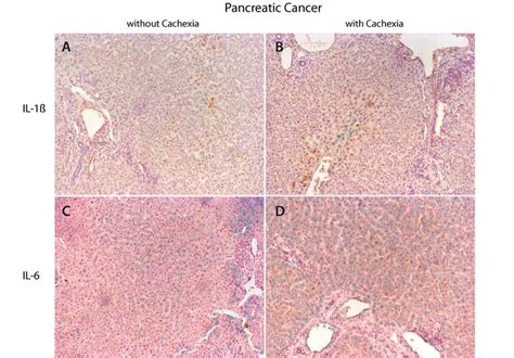 Immunohistochemistry In Liver Tissue Of Il 1ß And Il 6 From Patients