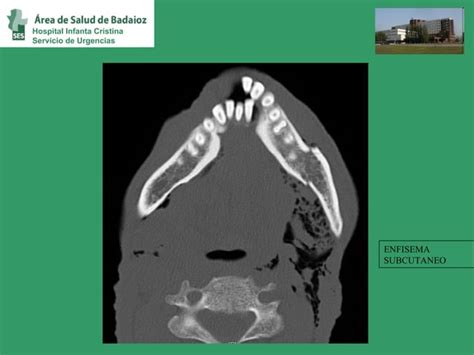 Fractura De Mandibula Dr Juanjo Arroyo Ppt Descarga Gratuita