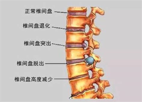 椎间盘突出有哪些症状？怀疑自己有椎间盘突出最适宜做哪种检查？ 12健康