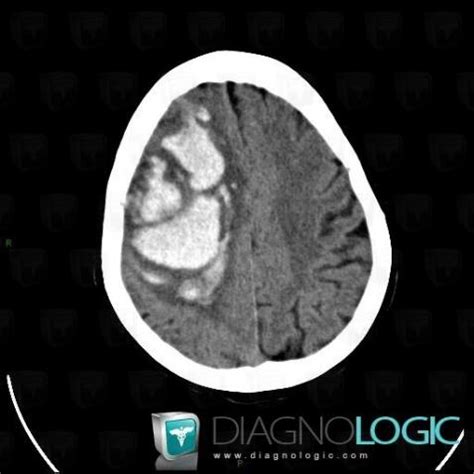 Radiology Case Hematoma Ct Diagnologic