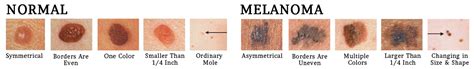 Skin Cancer Treatment Florida Dermatology And Skin Cancer Centers