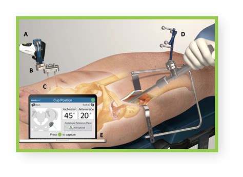 Knee Replacement - Re-flex Super Specialty Clinic