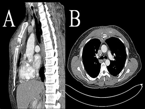 Computed tomography (CT scan) sternomanubrial joint bone erosion and... | Download Scientific ...