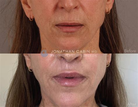 Lip Lift Vs Lip Filler Vs Lip Flip Cabinmd Facial Plastics And Aesthetics