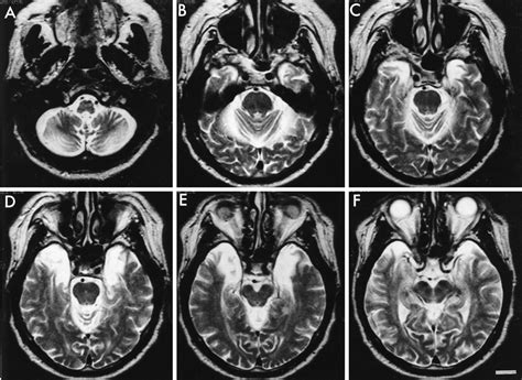 ms medial temporal lobe lesion findings  magnetic resonance