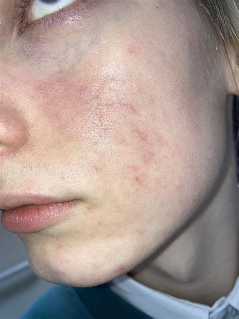Red blotches on face : r/skin