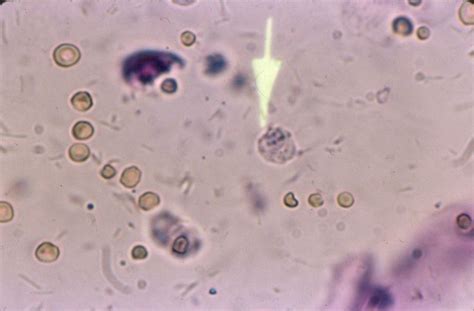 Wbc Cast In Urine