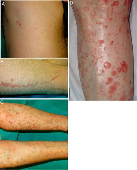 Porokeratosis Pictures Types Causes Treatment Eruptive Pruritic