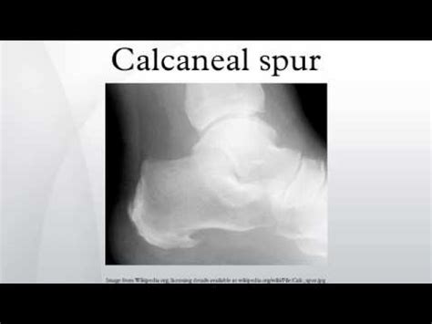 Spurs معنى / Bone Spurs Causes Symptoms Diagnosis Treatment Prevention : Spurs nation, san ...