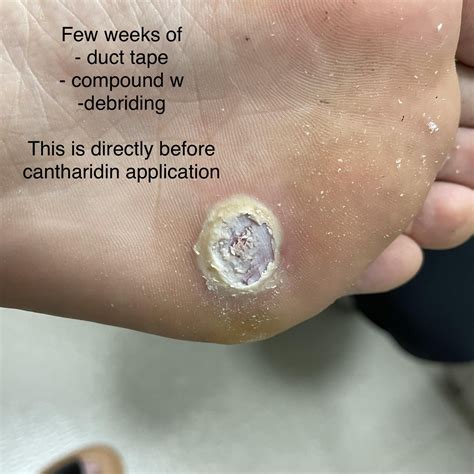 Persistent Plantar Wart (so painful) : r/Warts
