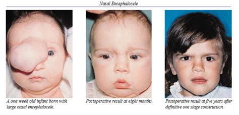 Encephalocele