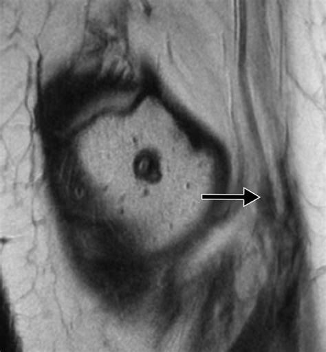 Pins And Needles From Fingers To Toes High Resolution Mri Of