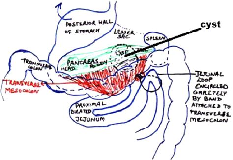 A band arising from inferior surface of transverse mesocolon encircling ...