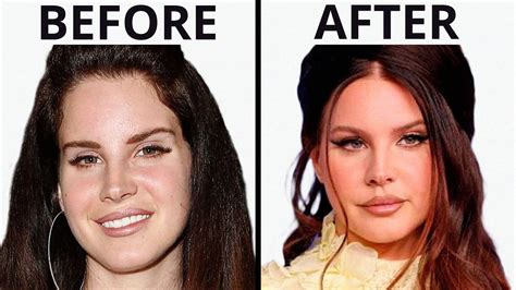 Lana Del Rey's SHOCKING Transformation | Plastic Surgery Analysis ...