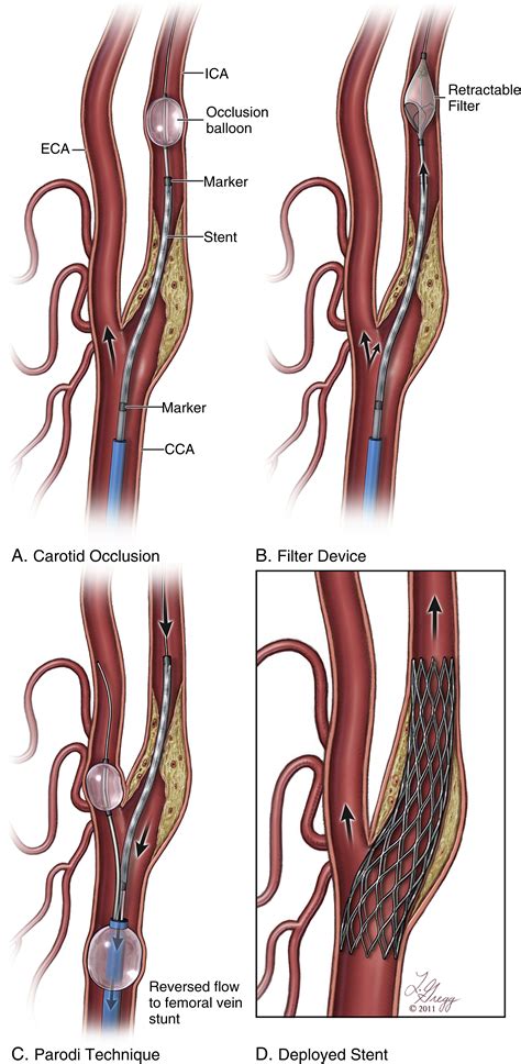 Carotid Revascularization - Clinical Tree