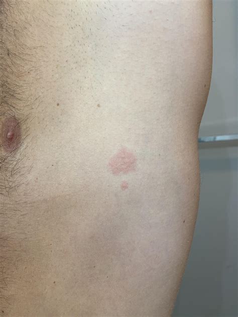 32/M 7 days after first rash. I have not experienced any blisters and ...