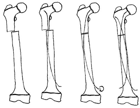 Fixation Of Proximal Third Femoral Shaft Fractures By Retrograde