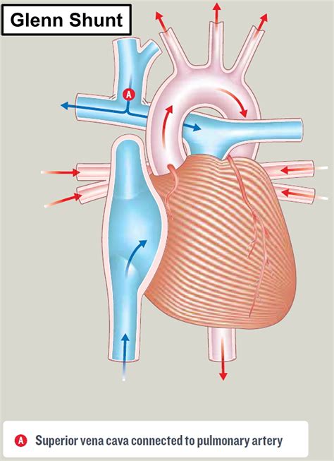 Hypoplastic Left Heart Syndrome - Causes, Prognosis, Surgery, Treatment