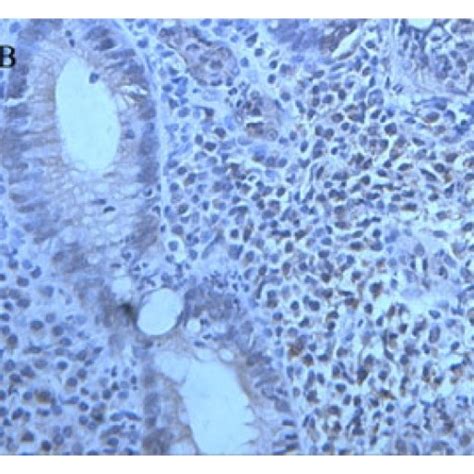 The expressions of IL 17 and TGF β1 in colonic mucosa in three groups