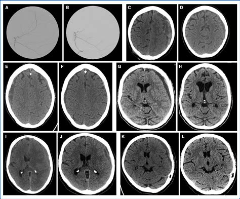 Figure 1 From Middle Meningeal Artery Embolization As Treatment For