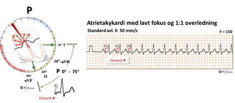 Index Of Elaring Fag Hjertesykdommer Spl Ekg Del Images