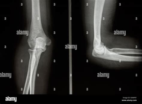 Film X Ray Elbow Aplateral Normal Humans Elbow Stock Photo Alamy