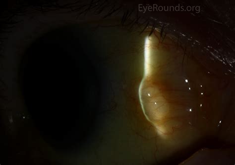 Atlas Entry Conjunctival Epithelial Inclusion Cyst
