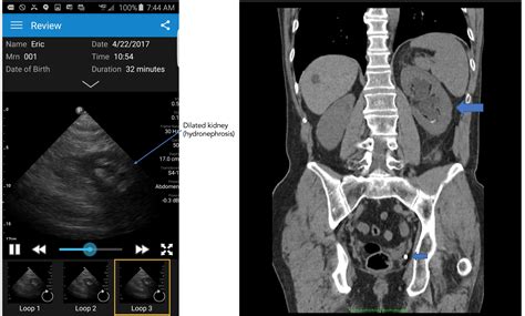 X Ray Or Ct Scan For Kidney Stone Urolithiasis | Radiology Reference