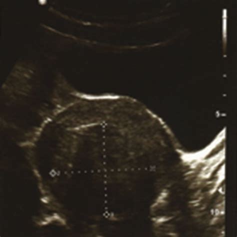 Pelvic Ultrasonography Revealing A Large Intramural Uterine Fibroid