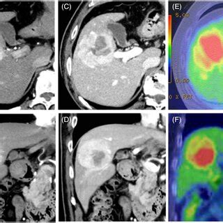 Findings Of Enhanced Abdominal Computed Tomography CT And F18