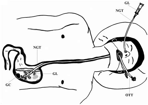 utility  nasogastric tube  medical  surgical oncology