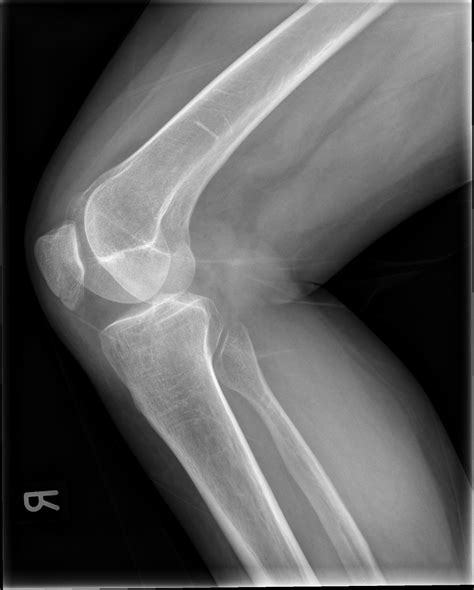 Фото Перелома Надколенника Без Смещения — Фото Картинки