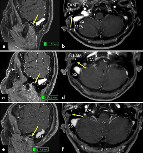 Post Contrast Sagittal A C E And Axial B D F T1 Weighted