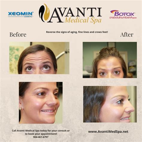 Achieve Natural Looking Results With Botox