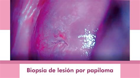 Lesión de papiloma en útero biopsia del cuello o cervix YouTube