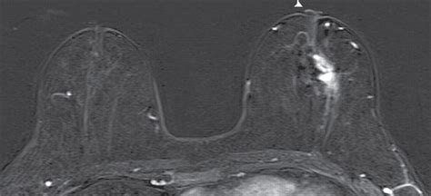 Paget Disease Of The Breast Mammographic US And MR Imaging Findings