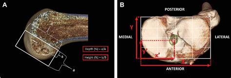 Figure From A Hybrid Transtibial Technique Combines The Advantages Of