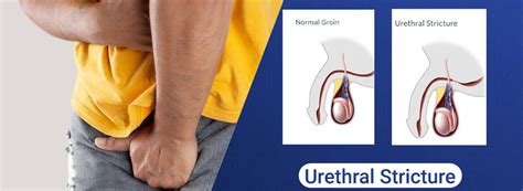 Urethral Stricture Causes Symptoms And Treatment Options