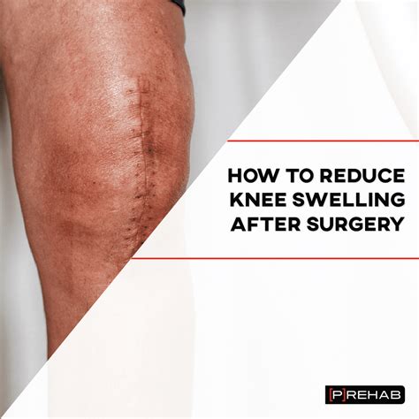 How Long Does Swelling Persists After Knee Replacement Surgery ...