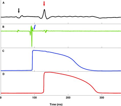 Example Of The Pseudo ECG A Bipolar Electrogram B And