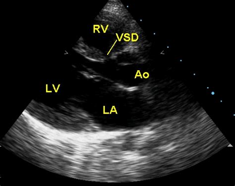 Echocardiographic Profile In Ventricular Septal Defect