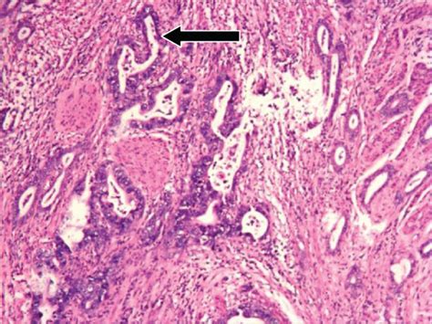 Representative Images Of Gastric Cardia Cancer Gcc A Gross Image