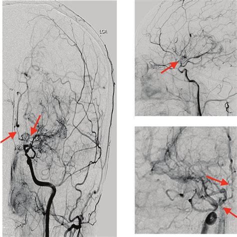 Digital Subtraction Angiography Images Of The A Left Internal Carotid