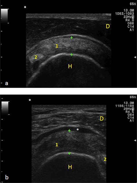 Ultrasound Appearance Of Normal And Degenerated Supraspinatus Tendon