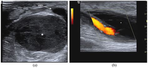 Dialysis Fistula Ultrasound